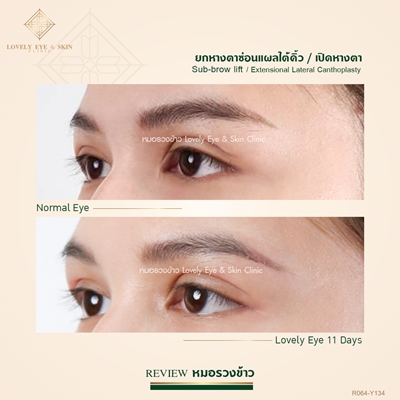 ยกหางตาซ่อนแผลใต้คิ้ว เปิดหางตา เทคนิคหมอรวงข้าว 46 (1).jpg