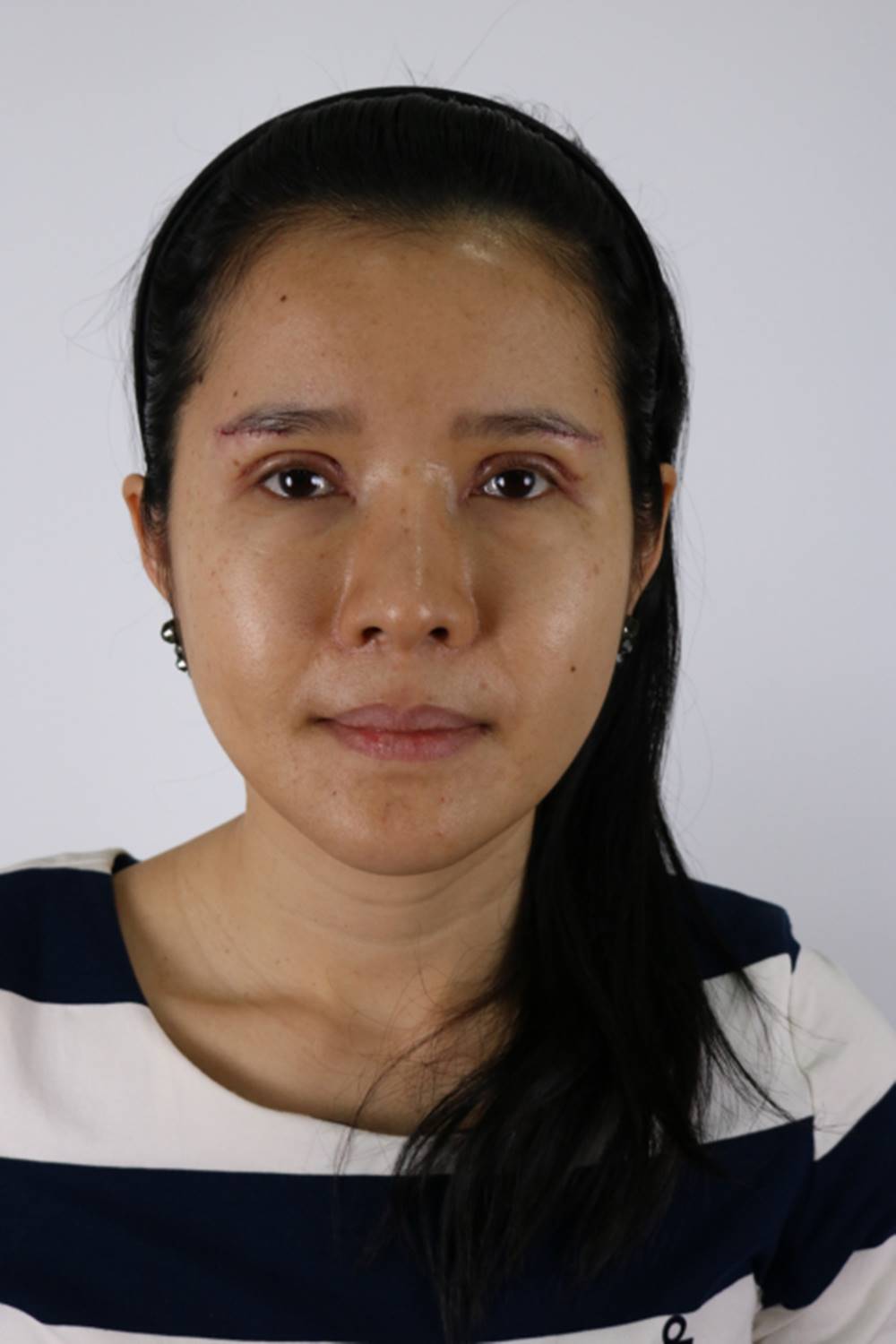 ยกหางตาซ่อนแผลใต้คิ้ว 20 (5).jpg