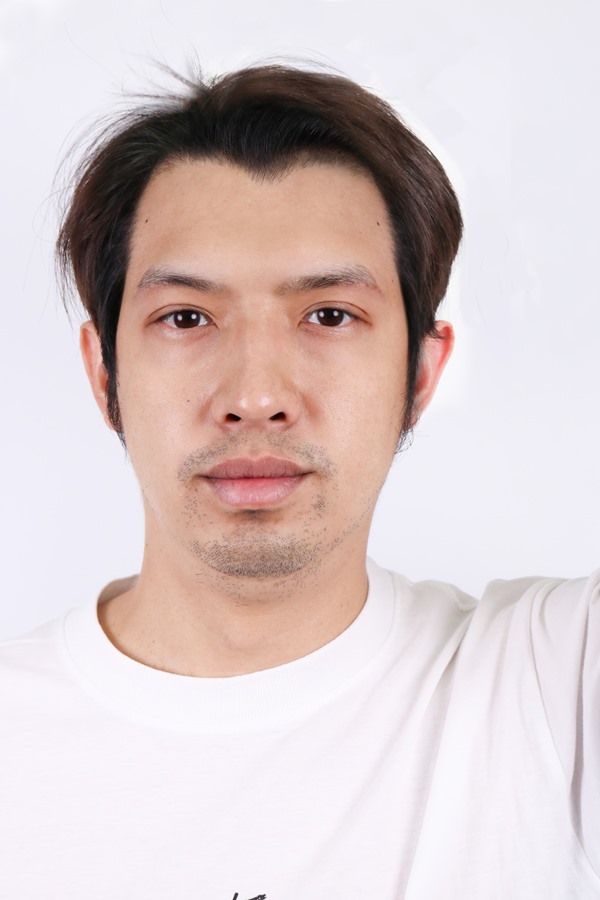 หลังยกหางตาซ่อนแผลใต้คิ้ว 1 เดือน ช่วยแก้ปัญหาหางตาตกได้ดีมากๆ ก่อนผ่าตัด หน้าผมดูเศร้า ไม่สดใส ดูง่วงนอน