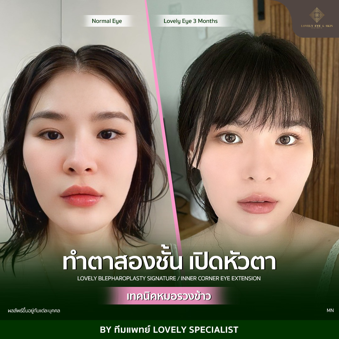 รีวิวทำตา 2 ชั้น ที่ Lovely Eye & Skin Clinic