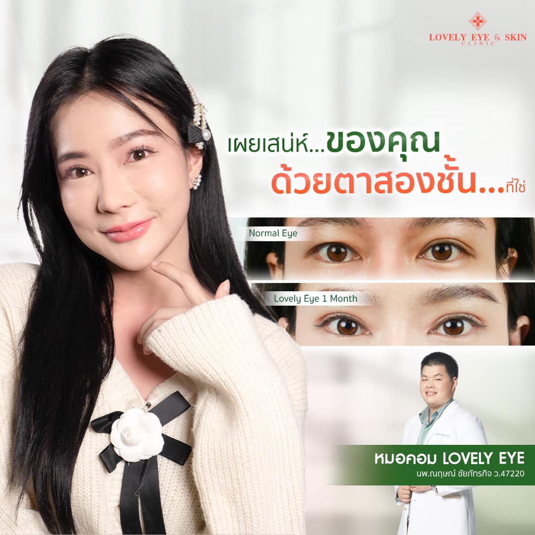 รีวิวศัลยกรรมตาปรับโหวงเฮ้งที่ Lovely Eye & Skin Clinic