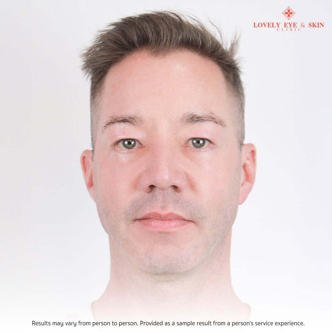 After blepharoplasty in Thailand