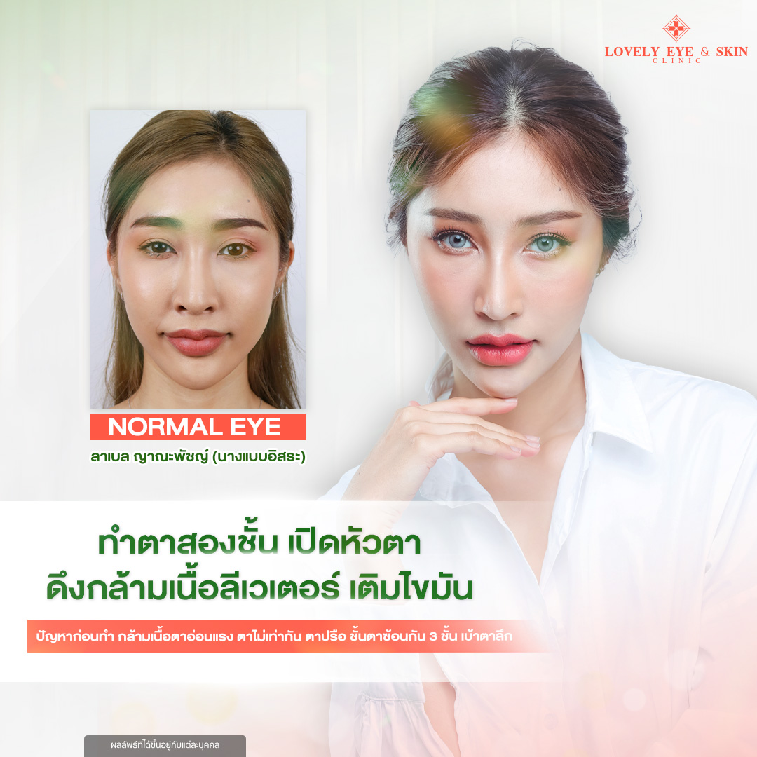 ศัลยกรรม ตาสองชั้นที่ Lovely Eye & Skin Clinic