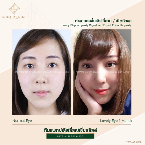 ศัลยกรรมตาสองชั้น (11)_0.jpg