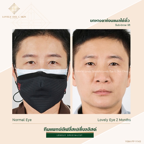 ศัลยกรรมตาสองชั้น (13).jpg