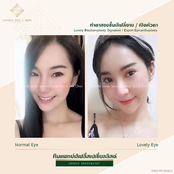 ศัลยกรรมตาสองชั้น (2)_0.jpg