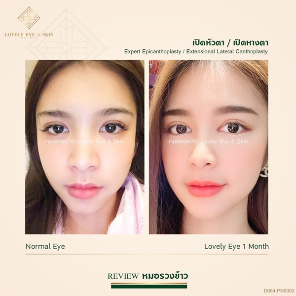 ศัลยกรรมตาสองชั้น (9)_0.jpg