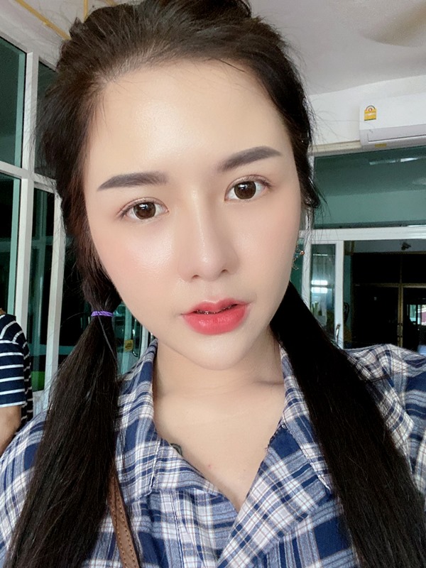 หลังศัลยกรรมตาสองชั้น ชั้นตาคมชัด ดูเท่ากันทั้งสองข้าง