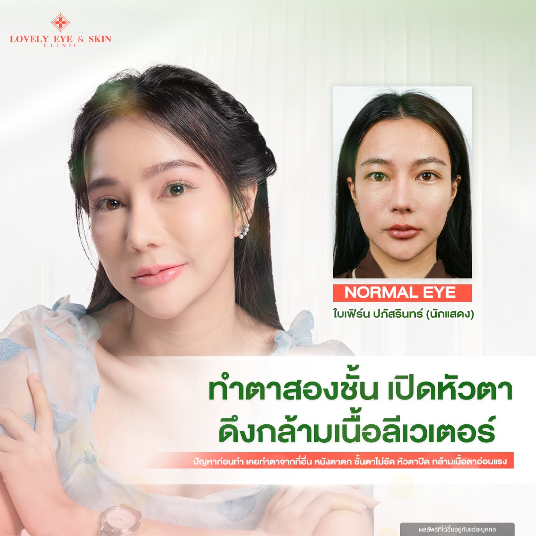 ศัลยกรรม ตาสองชั้นที่ Lovely Eye & Skin Clinic