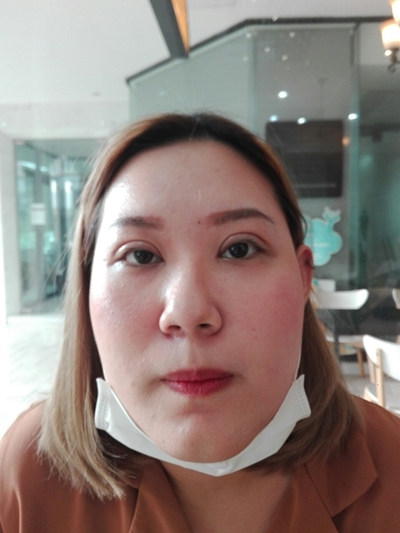ทำตาสองชั้น เปิดหัวตา ขนตาทิ่มตา