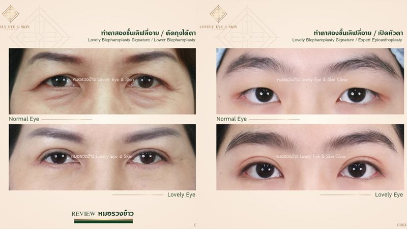 คนที่เคยหนังตาตก หลังทำจะเห็นขอบขาวตรงโคนขนตาชัด