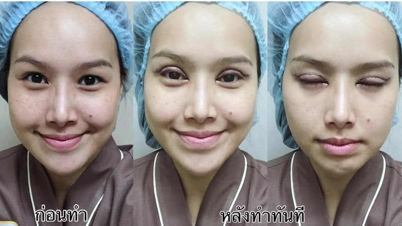 หลังทำตาสองชั้น ตาเรียวยาวขึ้น หน้าดูมีมิติขึ้นอย่างเห็นได้ชัด