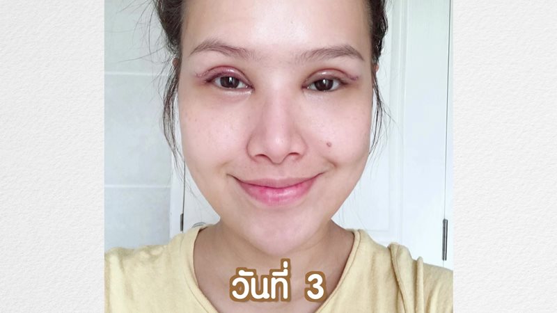 หลังทำตาสองชั้น 3 วัน ไม่มีความเขียวช้ำให้เห็น