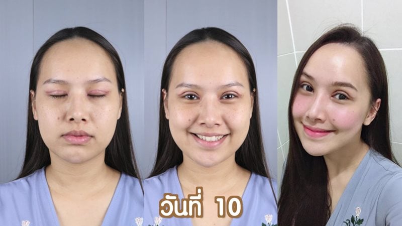 หลังทำตาสองชั้น 10 วัน ตัดไหม ชั้นตายังลึกอยู่ ต้องรอหายบวมสนิท