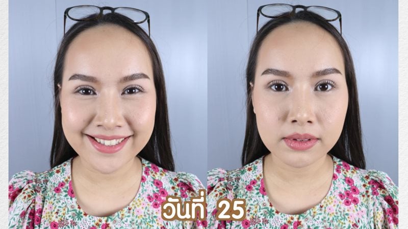 หลังทำตาสองชั้น 25 วัน ตาสวยกลมโต ดูหวานขึ้น ตาดูใหญ่ขึ้น