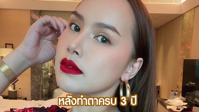 หลังทำตาสองชั้น 3 ปี ตาสวย ชั้นตาคมชัด ดูธรรมชาติ