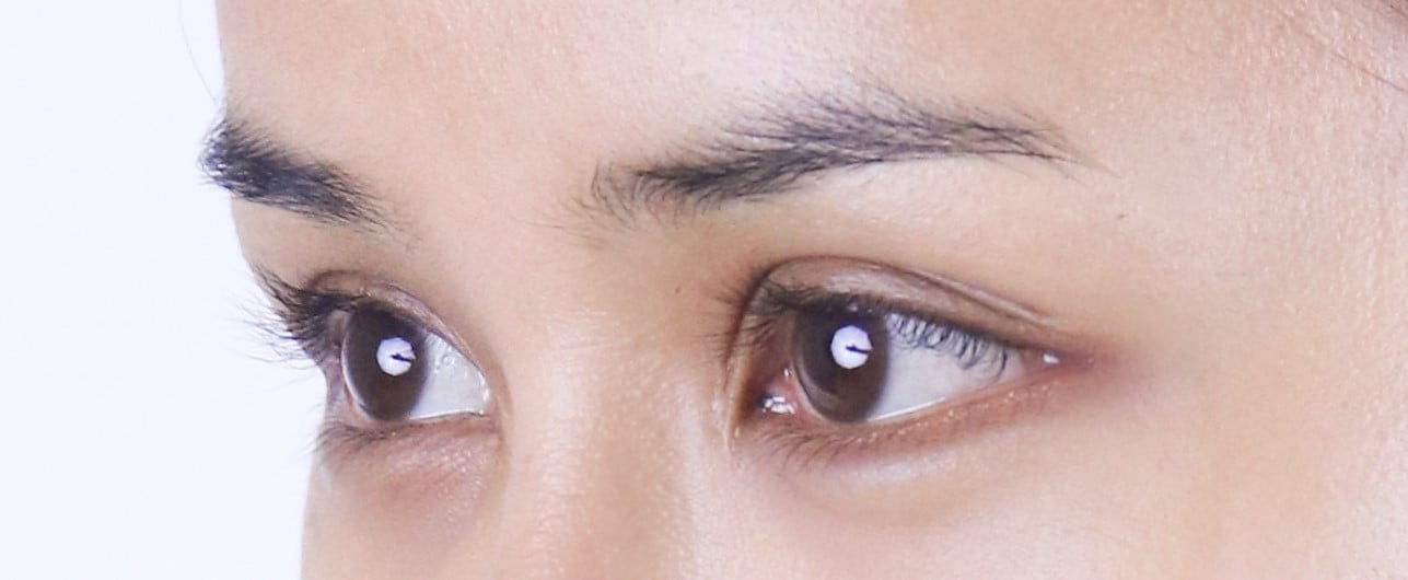 เคสเปิดหางตาเทคนิคหมอรวงข้าว Lovely Eye Clinic