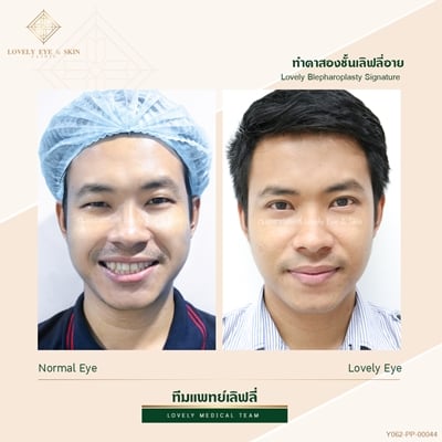 เบ้าตาแคบ ทำตาสองชั้น 1 (1).jpg