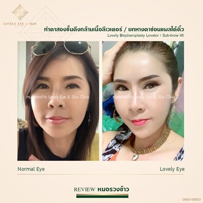 เบ้าตาแคบ ทำตาสองชั้น 1 (4).jpg