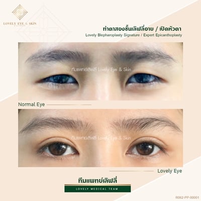 เบ้าตาแคบ ทำตาสองชั้น 1 (5)_0.jpg