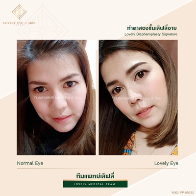 เบ้าตาแคบ ทำตาสองชั้น 1 (6).jpg
