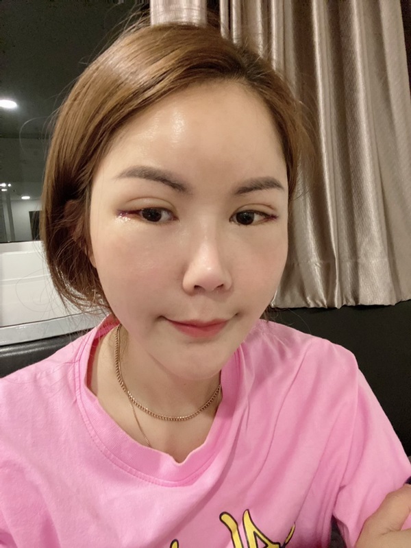 หลังเปิดหางตา 3 วัน แผลเล็กแบบตอนเปิดหัวตาเลย หางตาดูยาวเว่อร์วังมาก