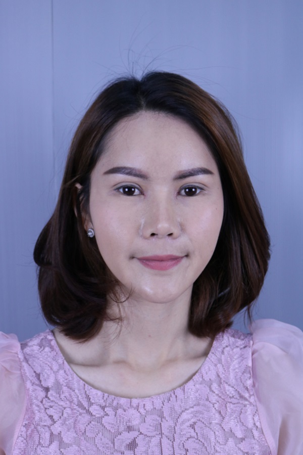 หลังเปิดหัวตา 10 วัน แผลหายแล้ว หัวตาดูกว้าง และขยายออก ทำให้ตาดูหวาน ได้สัดส่วน