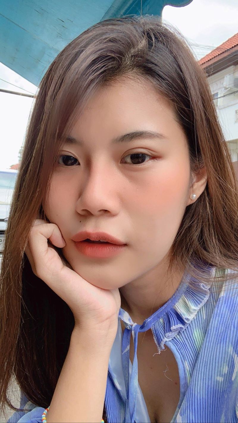 หลังเปิดหางตา 11 วัน แผลผ่าตัดเนียนไปกับหางตา ไม่เห็นรอยแผล