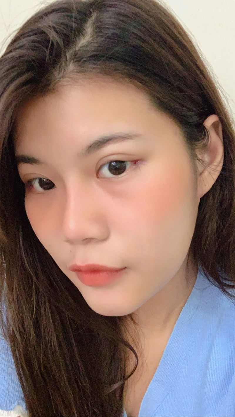 หลังเปิดหางตา 7 วัน รูปทรงตาเรียวยาว ดูสวยขึ้น