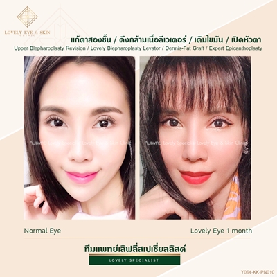 ดึงกล้ามเนื้อตา รักษากล้ามเนื้อตาอ่อนแรงเทคนิคหมอรวงข้าว