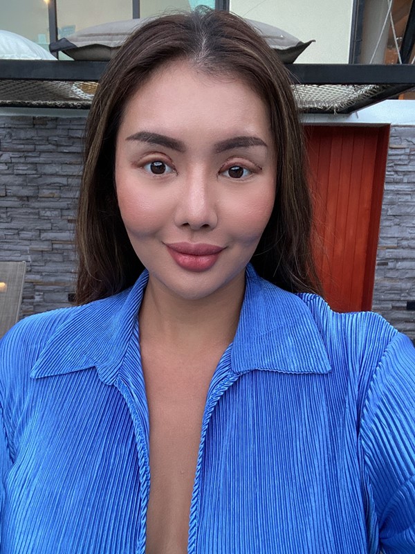 แก้ตาสองชั้น ดึงกล้ามเนื้อตา เปิดหัวตา 21_4_23 (1).jpg