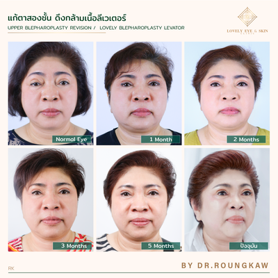 แก้ตาสองชั้น เทคนิคหมอรวงข้าว 10.png