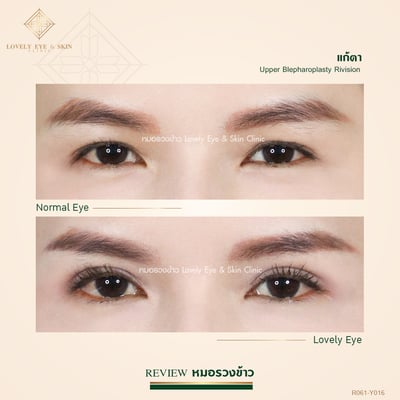 แก้ตาสองชั้น เทคนิคหมอรวงข้าว 1_0.jpg
