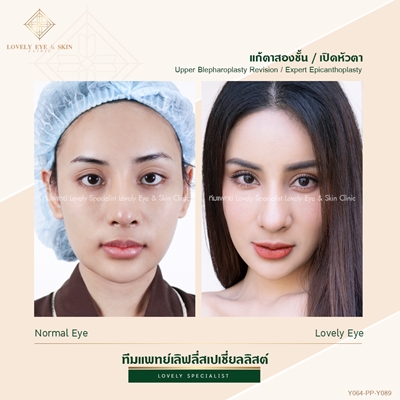 แก้ตาสองชั้น เทคนิคหมอรวงข้าว 5 (1).jpg
