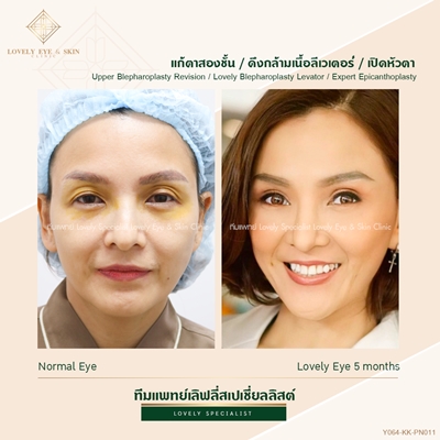 แก้ตาสองชั้น เทคนิคหมอรวงข้าว 5 (3).jpg