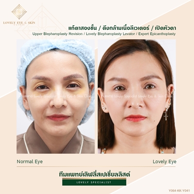 แก้ตาสองชั้น เทคนิคหมอรวงข้าว 5 (4).jpg