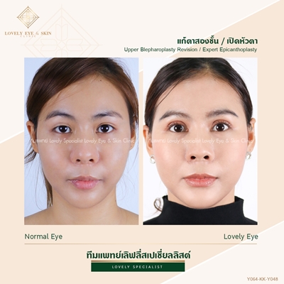 แก้ตาสองชั้น เทคนิคหมอรวงข้าว 5 (5).jpg