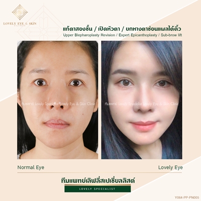 แก้ตาสองชั้น เทคนิคหมอรวงข้าว 5 (6).jpg