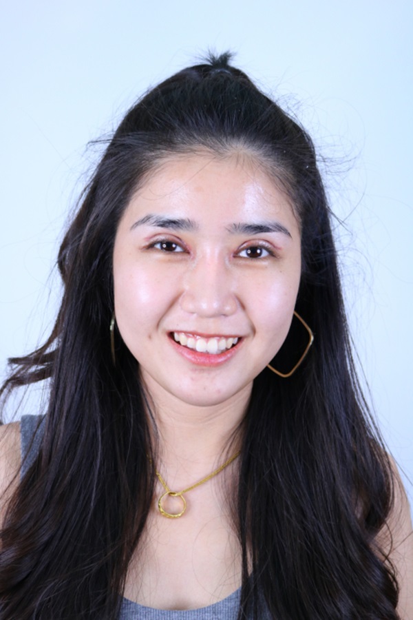 หลังแก้ตาสองชั้น+เปิดหัวตา 14 วัน ยุบบวม ตาเข้าที่ไว