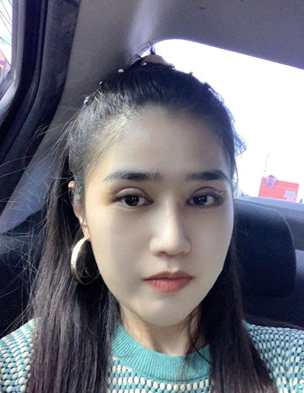หลังแก้ตาสองชั้น+เปิดหัวตา 5 วัน ตาโต ชั้นตาชัดเจน รูปทรงตาเปลี่ยนไป
