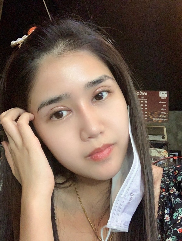 หลังแก้ตาสองชั้น+เปิดหัวตา 7 วัน แผลเนียน คุณหมอเย็บละเอียด และมือเบามาก