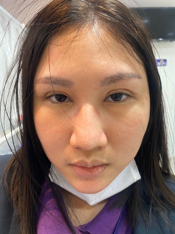 แก้ตาสองชั้น เปิดหัวตา 290922 (8).jpg