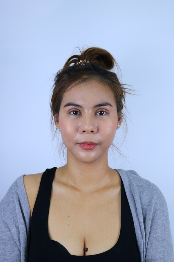 หลังแก้ตาสองชั้น+เปิดหัวตา 14 วัน หลังแก้ตา บวมน้อยมาก