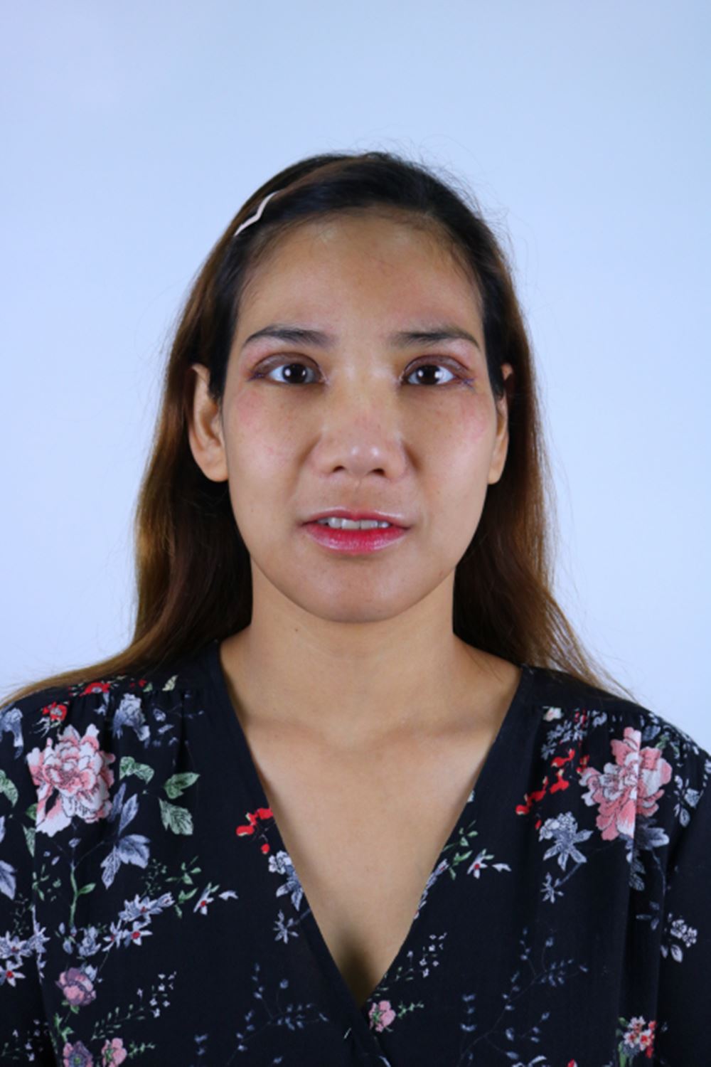 แก้ตาสองชั้น 20 (3).jpg
