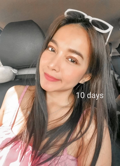 หลังแก้ตาสองชั้น 10 วัน ตาหวานขึ้น ตาโตขึ้นอย่างเห็นได้ชัด และดูเป็นธรรมชาติมากขึ้น