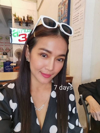 หลังแก้ตาสองชั้น 7 วัน ชั้นตาชัดเจน แก้หนังตาตก