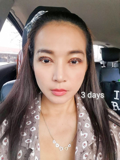 หลังแก้ตาสองชั้น 3 วัน ไม่บวม ชั้นตาโค้งพอดีกับรูปตา