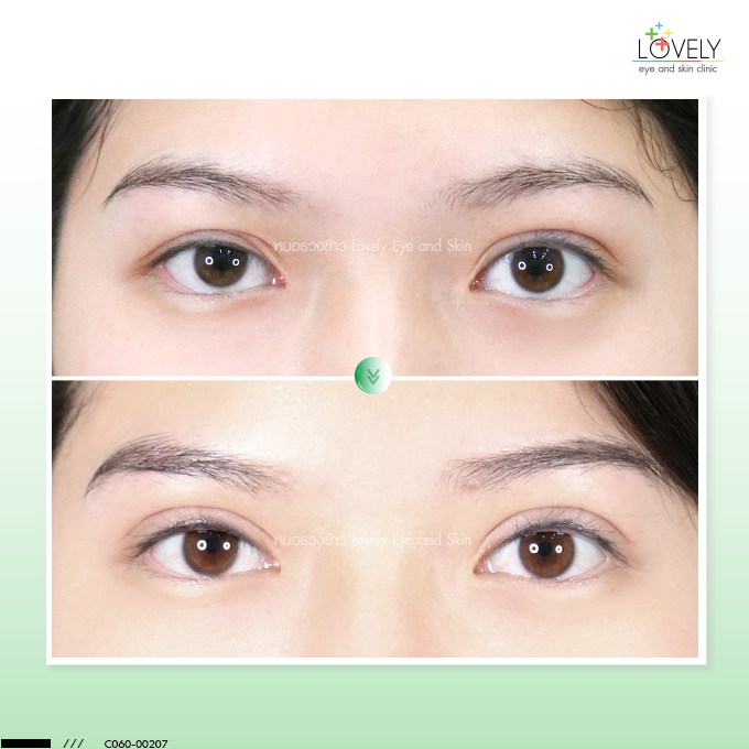 Performing upper blepharoplasty revision due to unequal eyelid creases