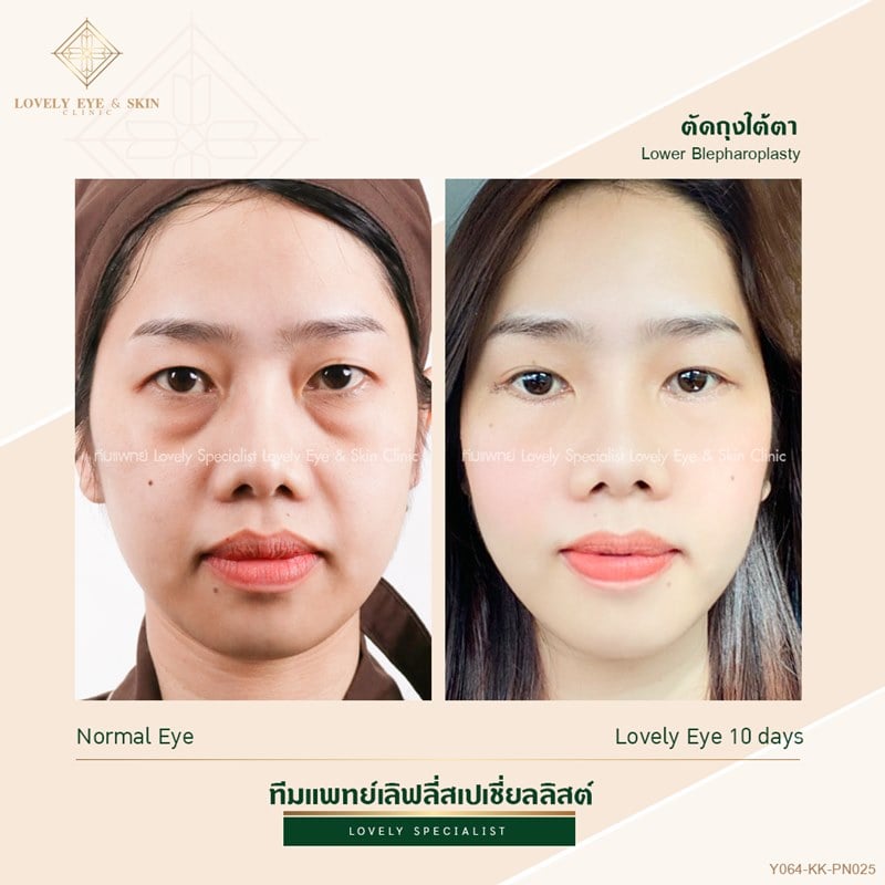 ใต้ตาคล้ำ (1).jpg