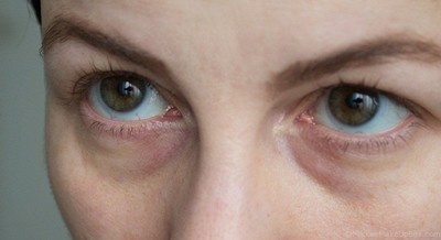 ใต้ตาคล้ำ ตาบวมแดง แสดงถึงความอิดโรย เห็นเส้นร่องน้ำตาได้ชัดเจน 
